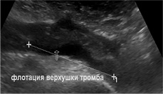 ультразвуковая картина флотирующего тромба, вызвавшего тромбоэмболию легочной артерии