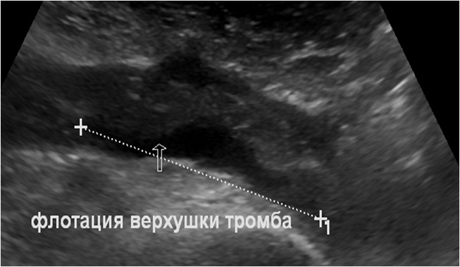 Узи вен тромбоз. УЗИ флотирующий тромб в общей бедренной Вене. Флотирующий тромбофлебит. Флотирующий тромб бедренной артерии.