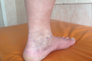 внешний вид ноги пациентки с варикозной болезнью